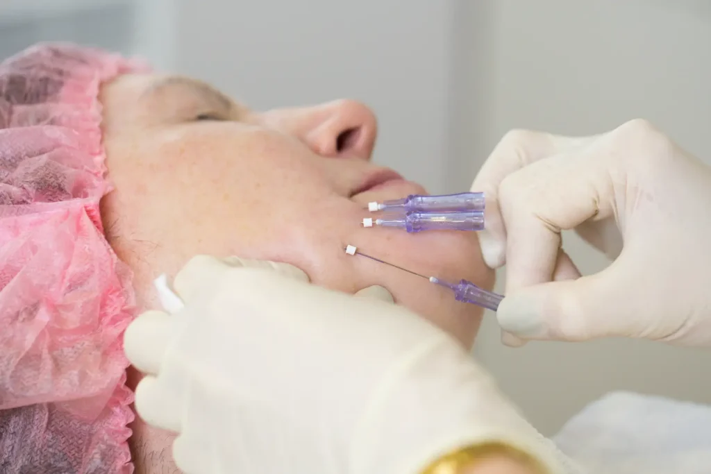 Gloved practitioner positions several fine threads along a woman's lower cheek and jaw area.