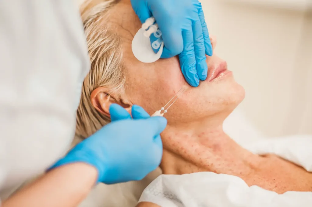 Practitioner in blue gloves positions fine threads along a mature woman's cheek during a facial procedure.