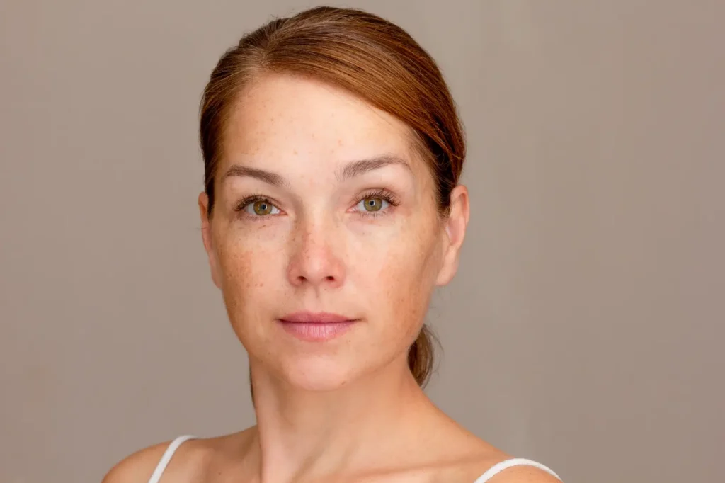Woman with freckles and visible facial pigmentation looks directly at the camera against a neutral background.